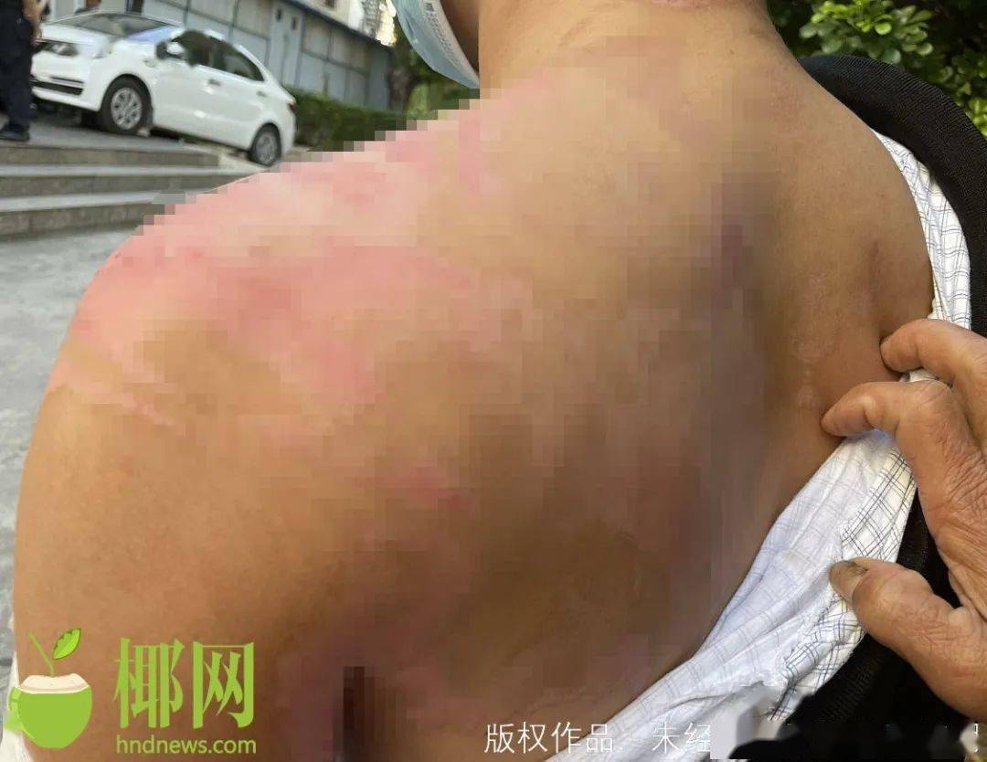 男子拔火罐遭遇大面积烧伤事件，事故警示与反思