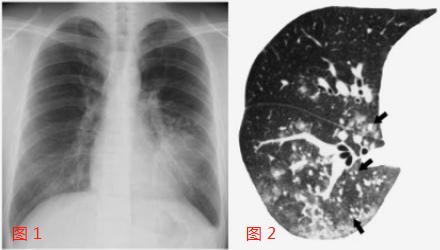 男子甲流后患病毒性肺炎，四肢末端花斑——警示与应对