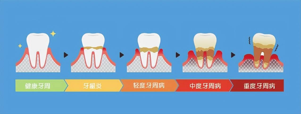 牙周病患者的脑卒中风险及预防应对策略